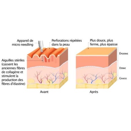 Microneedling & BB glow