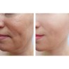 Microneedling & BB glow