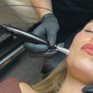 15 cartridges of 6 HR tips for Microneedling - Signature® by BIOTIC Phocea